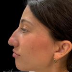 Liquid Rhinoplasty(Non-Surgical) Before & After Patient #19229