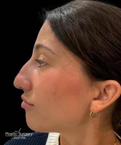 Liquid Rhinoplasty(Non-Surgical) Before & After Patient #19229