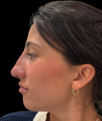 Liquid Rhinoplasty(Non-Surgical) Before & After Patient #19229