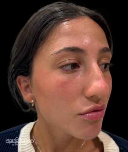 Liquid Rhinoplasty(Non-Surgical) Before & After Patient #19229