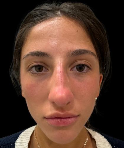 Liquid Rhinoplasty(Non-Surgical) Before & After Patient #19229