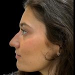 Liquid Rhinoplasty(Non-Surgical) Before & After Patient #19230