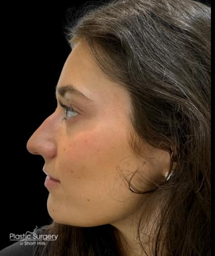 Liquid Rhinoplasty(Non-Surgical) Before & After Patient #19230