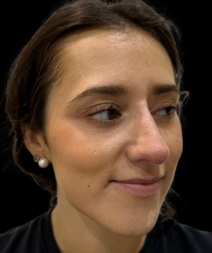 Liquid Rhinoplasty(Non-Surgical) Before & After Patient #19230