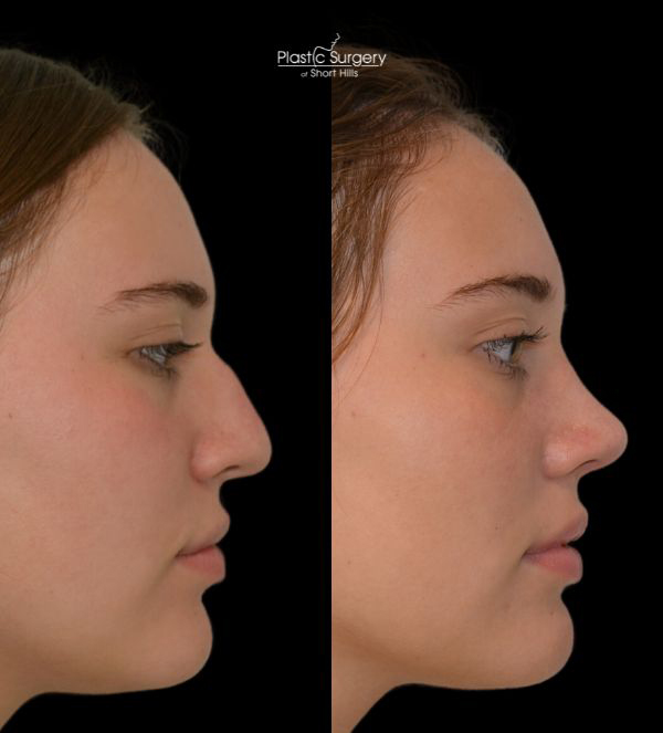 specials rhinoplasty