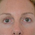 Blepharoplasty Before & After Patient #19259