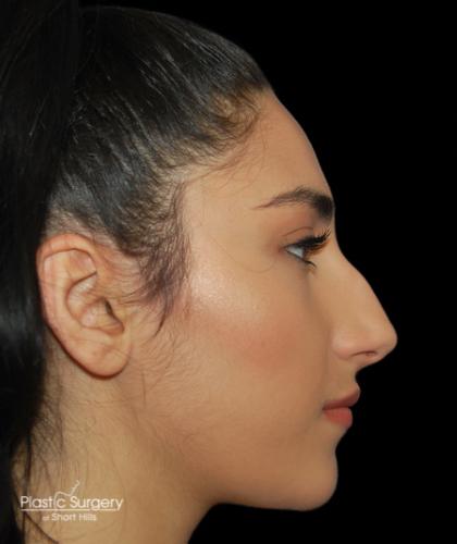 Rhinoplasty Before & After Patient #19280