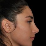 Rhinoplasty Before & After Patient #19280