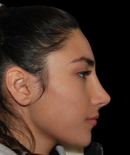 Rhinoplasty Before & After Patient #19280