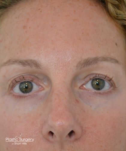 Blepharoplasty Before & After Patient #19259