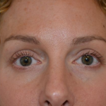 Blepharoplasty Before & After Patient #19259