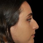 Rhinoplasty Before & After Patient #19281