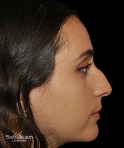 Rhinoplasty Before & After Patient #19281