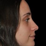 Rhinoplasty Before & After Patient #19281