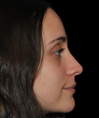 Rhinoplasty Before & After Patient #19281