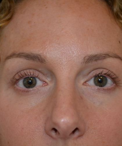 Blepharoplasty Before & After Patient #19259