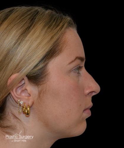 Rhinoplasty Before & After Patient #19282