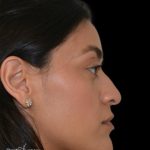 Rhinoplasty Before & After Patient #19283