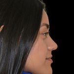 Rhinoplasty Before & After Patient #19283