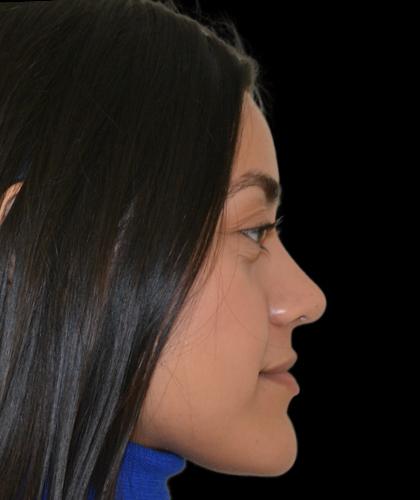 Rhinoplasty Before & After Patient #19283