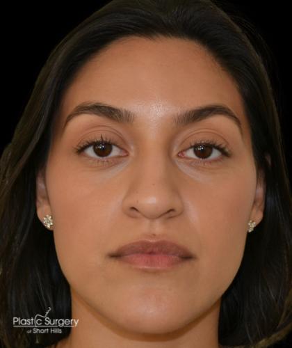 Rhinoplasty Before & After Patient #19283