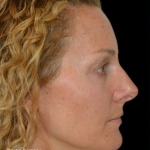 Blepharoplasty Before & After Patient #19259