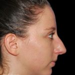 Rhinoplasty Before & After Patient #19284