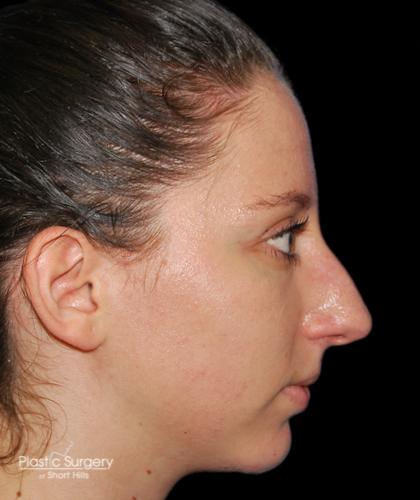 Rhinoplasty Before & After Patient #19284