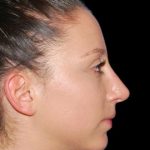 Rhinoplasty Before & After Patient #19284