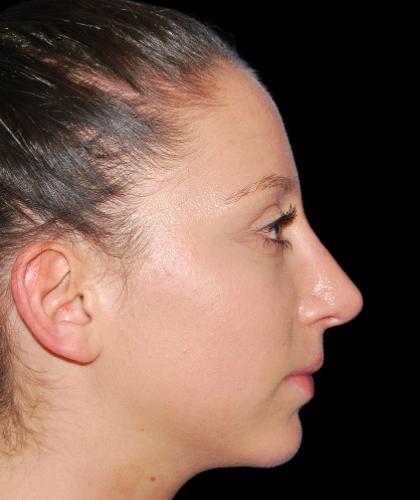 Rhinoplasty Before & After Patient #19284