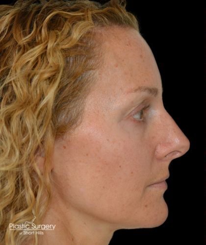 Blepharoplasty Before & After Patient #19259