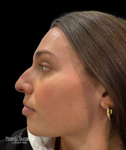 Liquid Rhinoplasty(Non-Surgical) Before & After Patient #19336