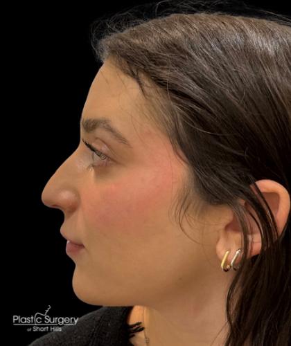 Liquid Rhinoplasty(Non-Surgical) Before & After Patient #19317