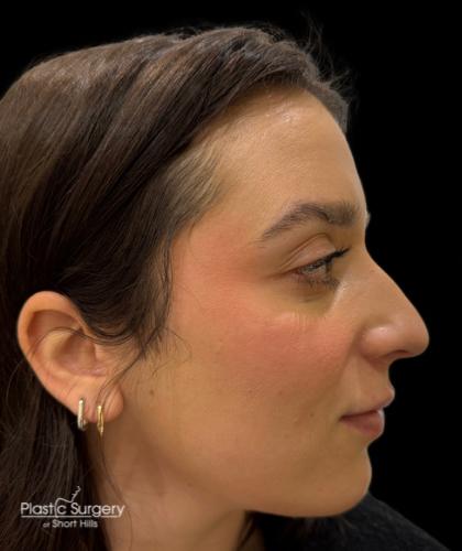 Liquid Rhinoplasty(Non-Surgical) Before & After Patient #19317