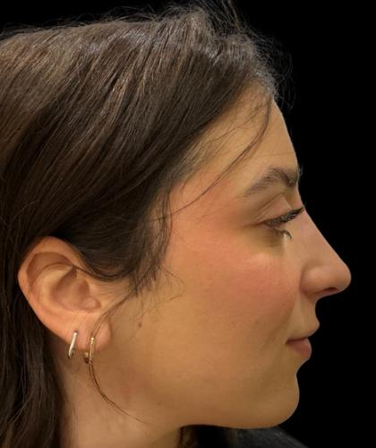 Liquid Rhinoplasty(Non-Surgical) Before & After Patient #19317