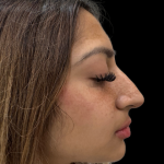 Liquid Rhinoplasty(Non-Surgical) Before & After Patient #19362