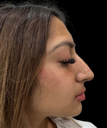 Liquid Rhinoplasty(Non-Surgical) Before & After Patient #19362