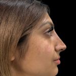 Liquid Rhinoplasty(Non-Surgical) Before & After Patient #19362