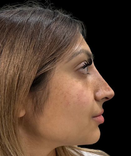 Liquid Rhinoplasty(Non-Surgical) Before & After Patient #19362