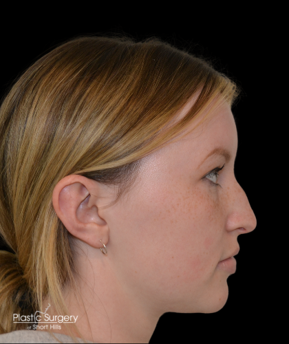 Rhinoplasty Before & After Patient #19329