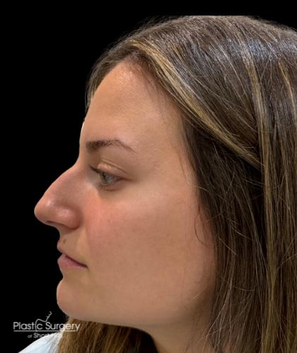 Liquid Rhinoplasty(Non-Surgical) Before & After Patient #19318