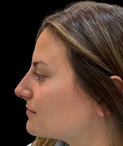 Liquid Rhinoplasty(Non-Surgical) Before & After Patient #19318