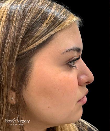 Liquid Rhinoplasty(Non-Surgical) Before & After Patient #19338