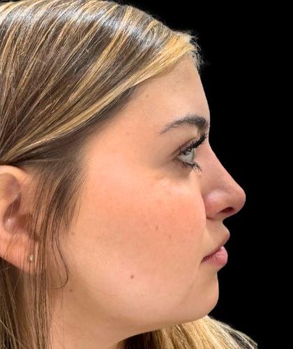 Liquid Rhinoplasty(Non-Surgical) Before & After Patient #19338