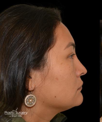 Revision Rhinoplasty Before & After Patient #19349