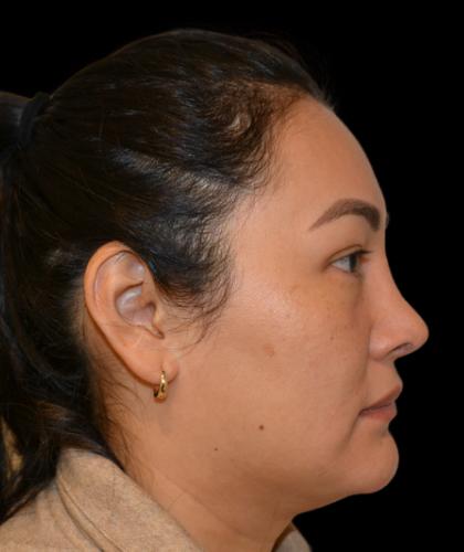 Revision Rhinoplasty Before & After Patient #19349