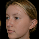 Rhinoplasty Before & After Patient #19329