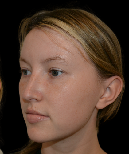 Rhinoplasty Before & After Patient #19329