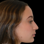 Rhinoplasty Before & After Patient #19388