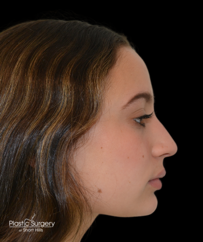 Rhinoplasty Before & After Patient #19388